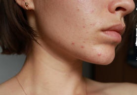 EVERYTHING YOU SHOULD KNOW ABOUT PIMPLES